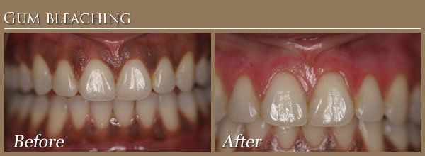 gum disease before and after