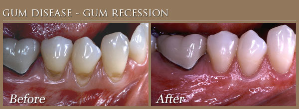 gum disease gum recession2