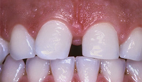 teeth gap before
