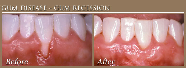 The Cost Of Gum Disease Treatment In Los Angeles